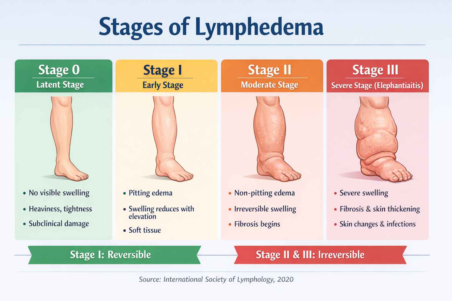 Lymphedema Management in Advanced Cancer: A Gentle Approach