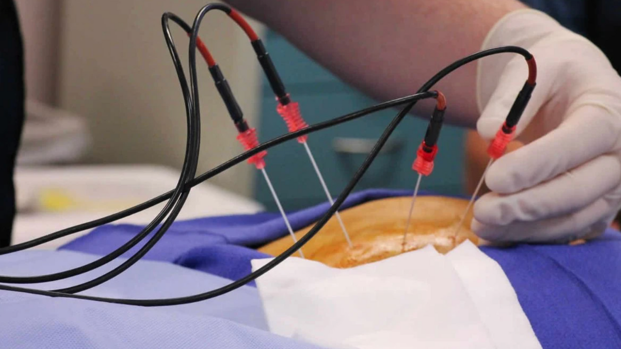 Interventional Pain Procedures: Nerve Blocks, Epidurals, and Radiofrequency Ablation